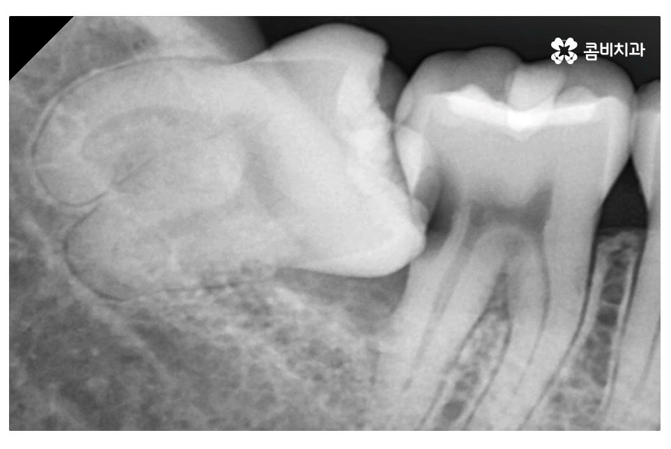 누운 사랑니 발치와 어금니신경치료를 하게 된 사례 관련 이미지 3