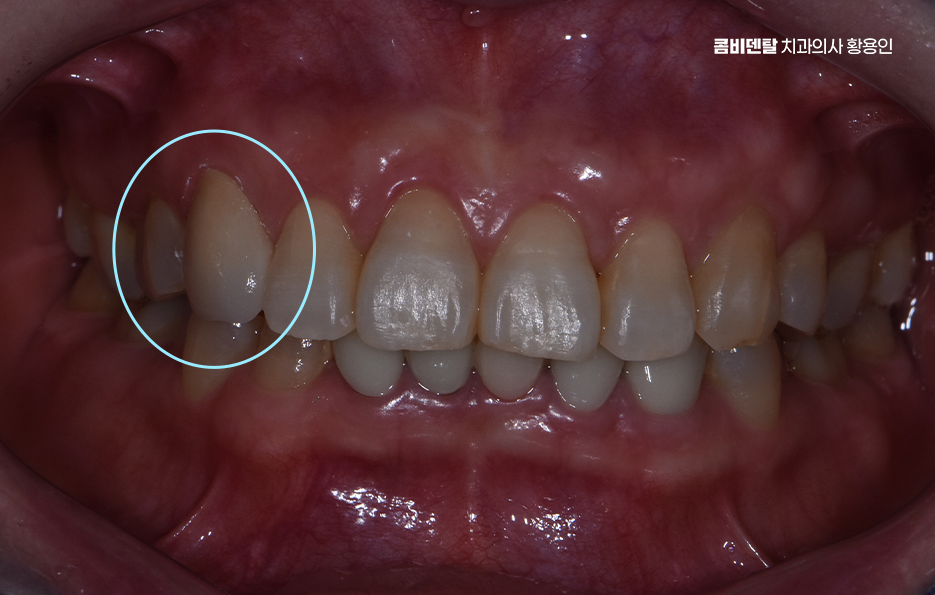 송곳니 크라운 티가 안나게 해결 가능한건가요 관련 이미지 7