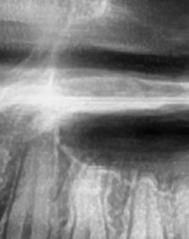 어금니 뒤 잇몸 부음 어떤 문제길래 이런거죠 관련 이미지 24
