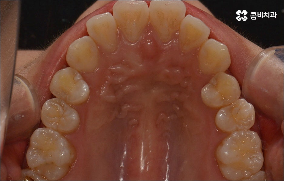 앞니 돌출 어떻게 고치나요? 관련 이미지 7
