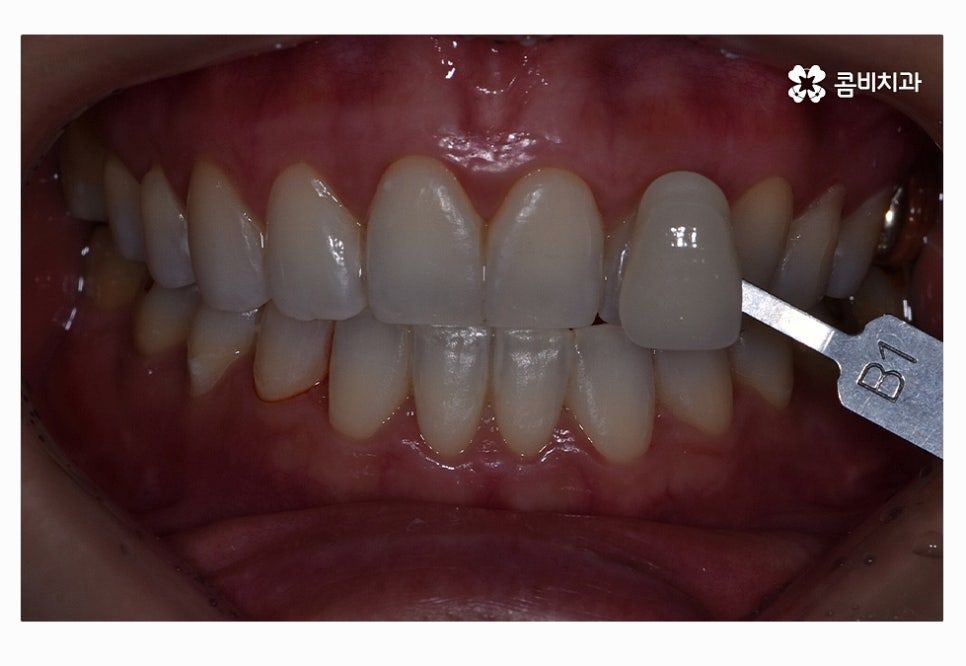 누런이로 고민하시는 분들을 위한 치아미백 정보 관련 이미지 6