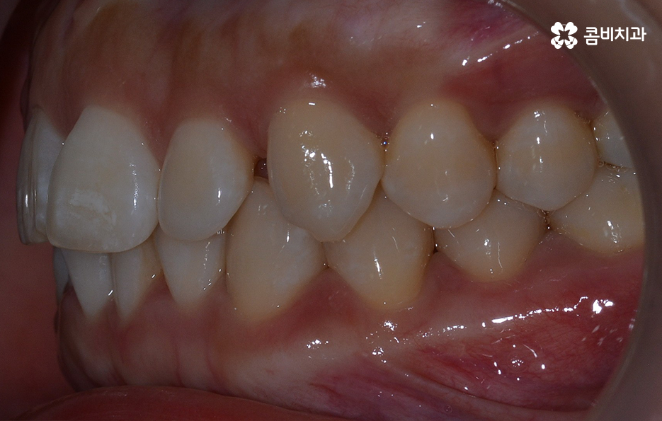 비발치치아교정 고민되는데 발치하면 안좋나요 관련 이미지 6