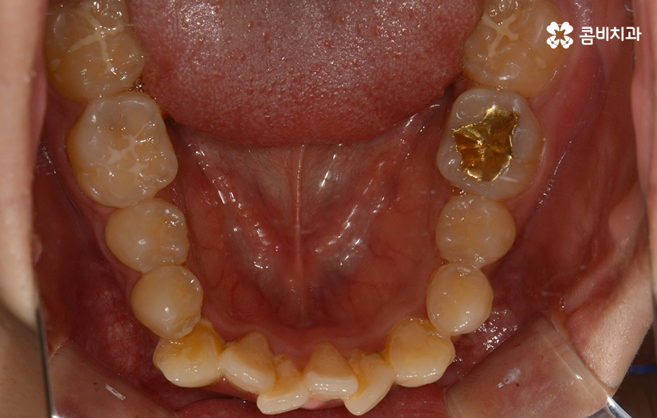 덧니교정 불편함이 느껴지지 않더라도 관련 이미지 5