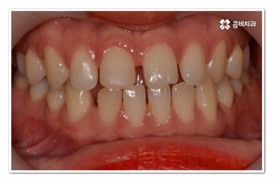 앞니 벌어짐 똑똑하게 해결하려면 관련 이미지 1