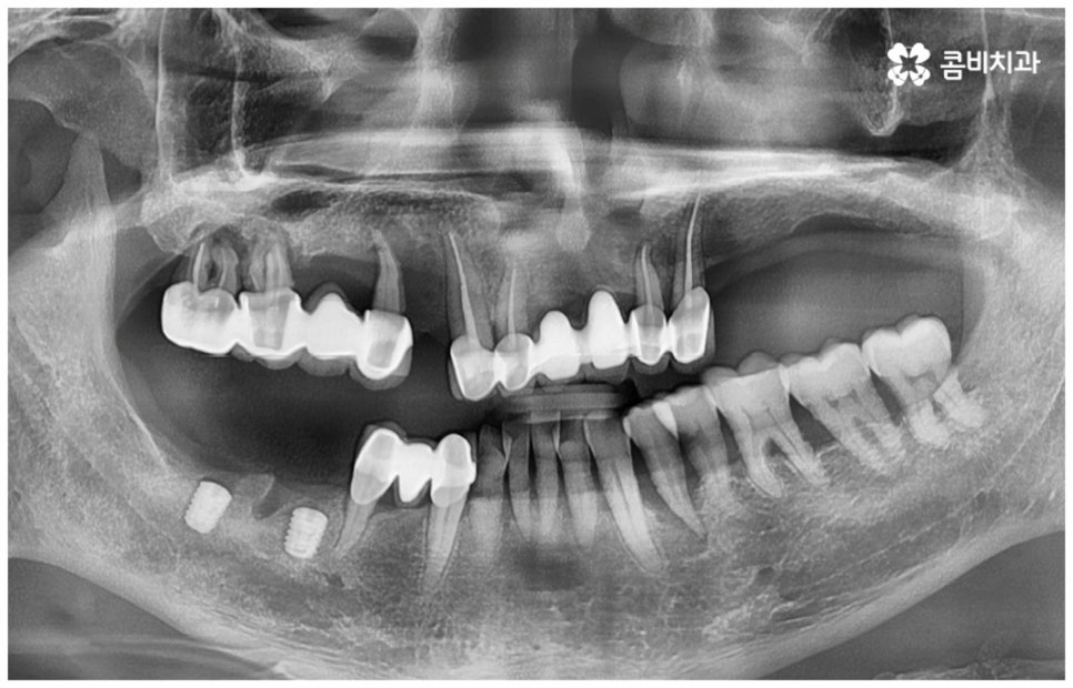 임플란트수명 연장하려면? 관련 이미지 2