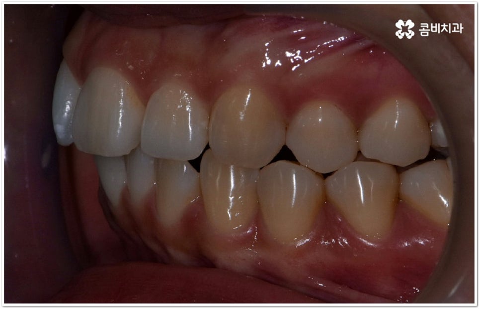 덧니부분교정 시작하려면 관련 이미지 5