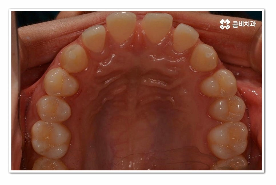 앞니 벌어짐 똑똑하게 해결하려면 관련 이미지 4