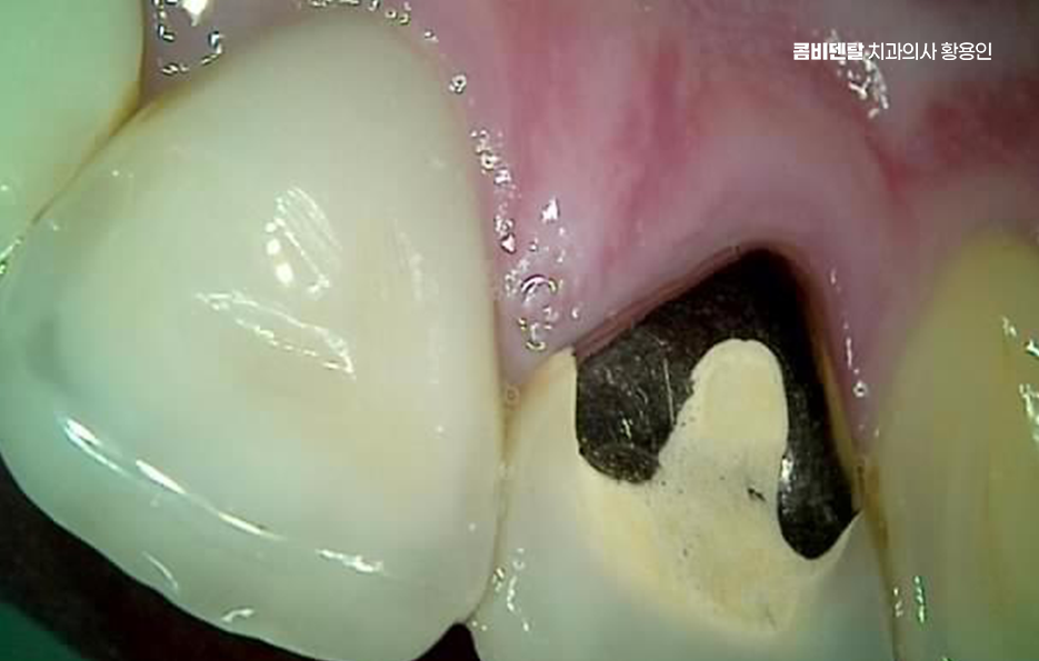 앞니 신경치료 크라운 까지 해야할 상황이라면 관련 이미지 3