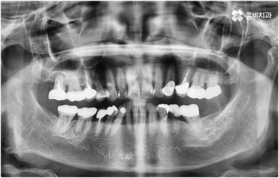 어금니임플란트 살펴볼 사항들은 무엇인가요? 관련 이미지 1
