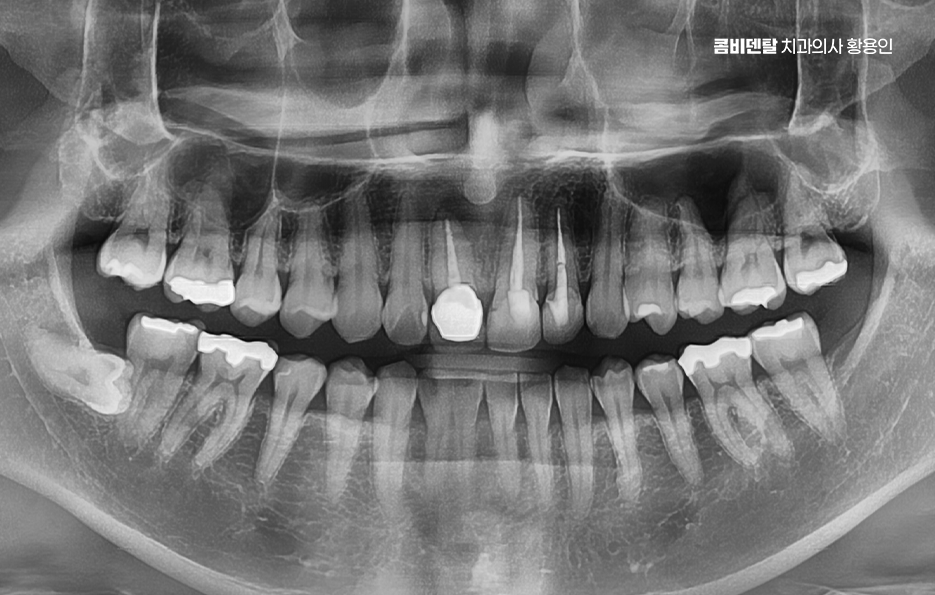 앞니 신경치료 크라운 까지 해야할 상황이라면 관련 이미지 1