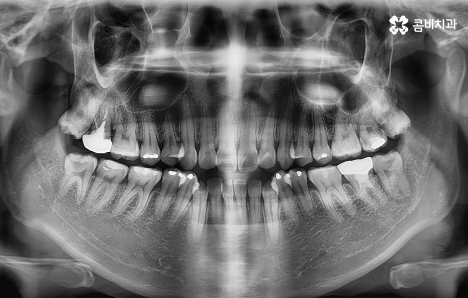클리피씨교정 알아볼 때 꼭 신경 써야 하는 점은! 관련 이미지 6
