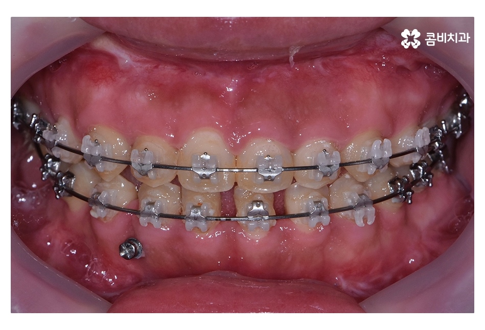 클리피씨교정 늦지않게 결정하려면 관련 이미지 10