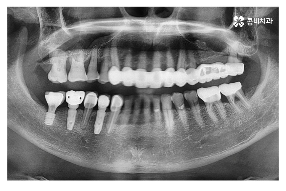 임플란트 기간 케이스에 따라 달라진다면 관련 이미지 6