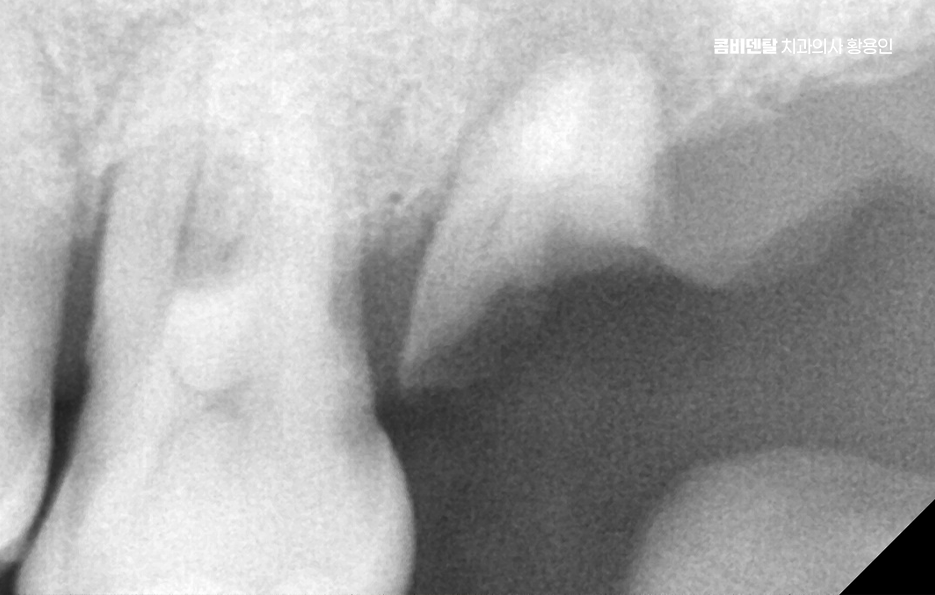 어르신 임플란트 지원 현명하게 활용하려면 관련 이미지 3