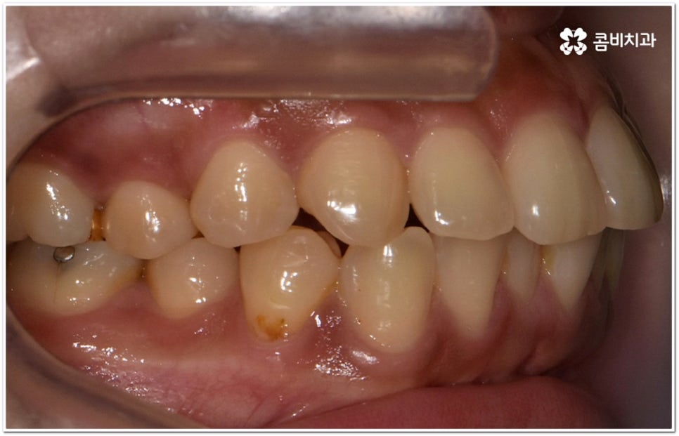 돌출입교정치과 알아보는 기준은 관련 이미지 5