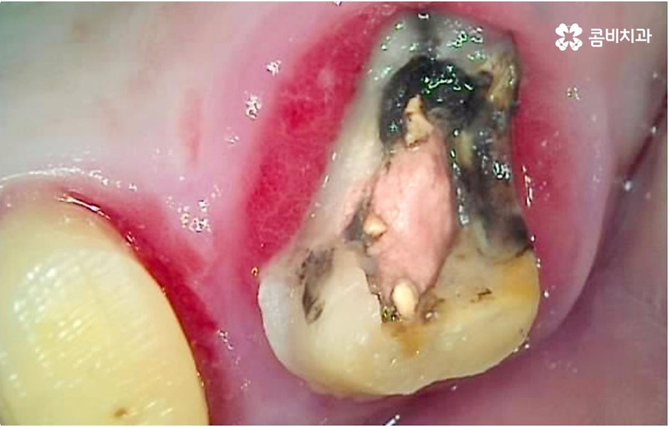 명동치과 타고난 이의 수명은 관련 이미지 5