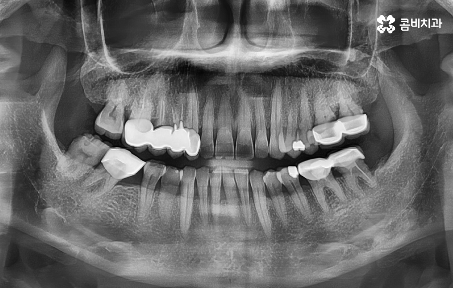 명동치과 놓치기 쉬운 2차충치에 주의하려면 관련 이미지 1
