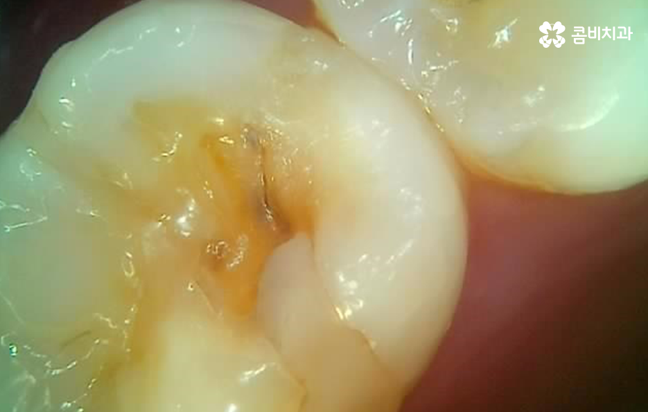 어금니 레진 깨짐 변색 안아파도 이렇게 대처하세요 관련 이미지 7