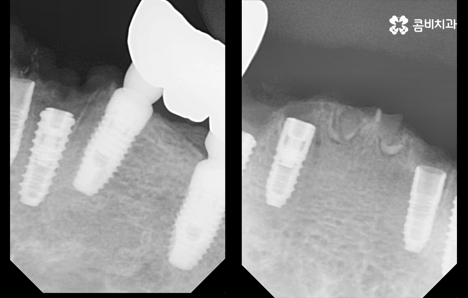 발치후 임플란트 기간 현실적으로 알아보면 관련 이미지 4