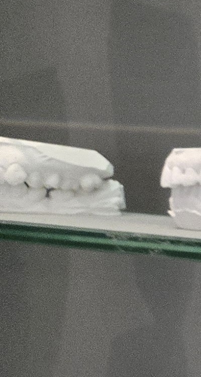 윗니 전체 임플란트 뭐부터 해야할까 관련 이미지 20