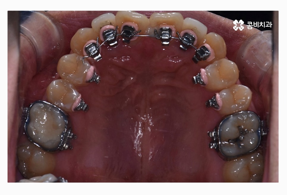 콤비교정 올바르게 판단하려면 관련 이미지 9