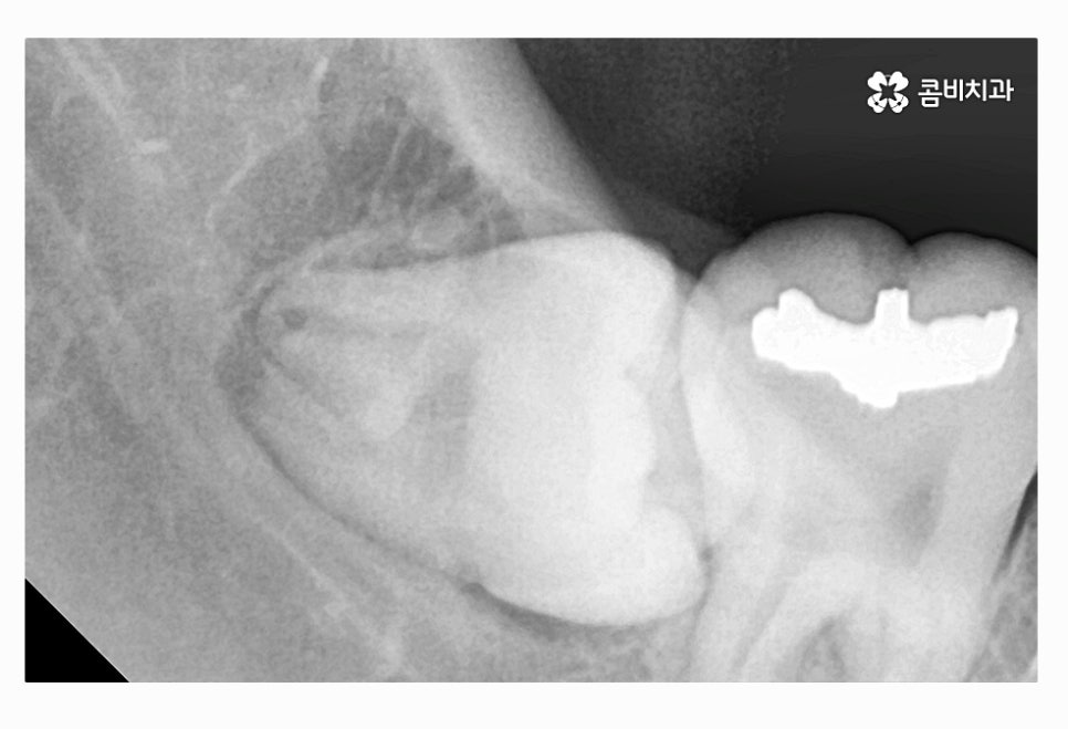 사랑니 충치 현명하게 접근하려면 관련 이미지 9