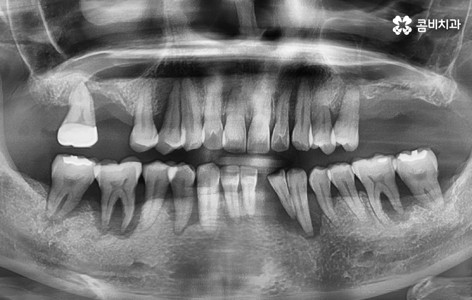 치아 옆면 충치 이렇게 무섭습니다 관련 이미지 1