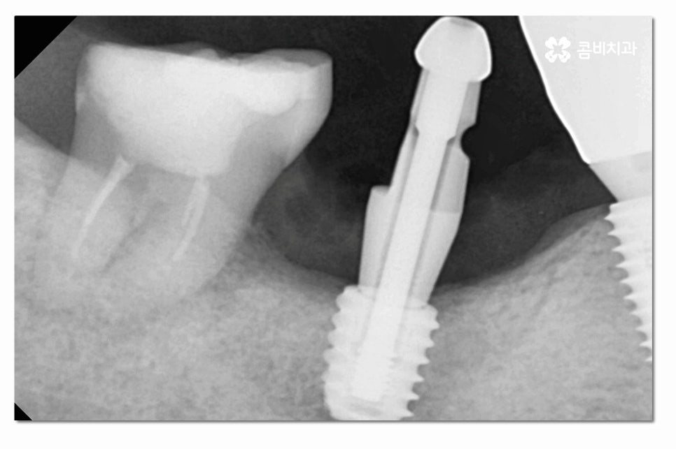 어금니임플란트 합리적으로 알아보려면 관련 이미지 6