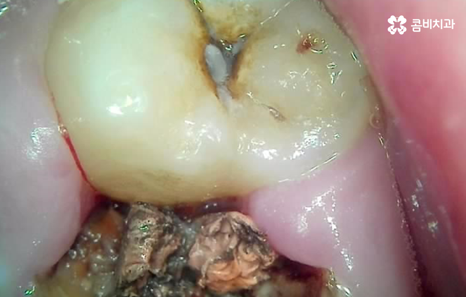 어금니 충치 발치 결국 뽑아야 할때와 살릴 수 있는 케이스 관련 이미지 3