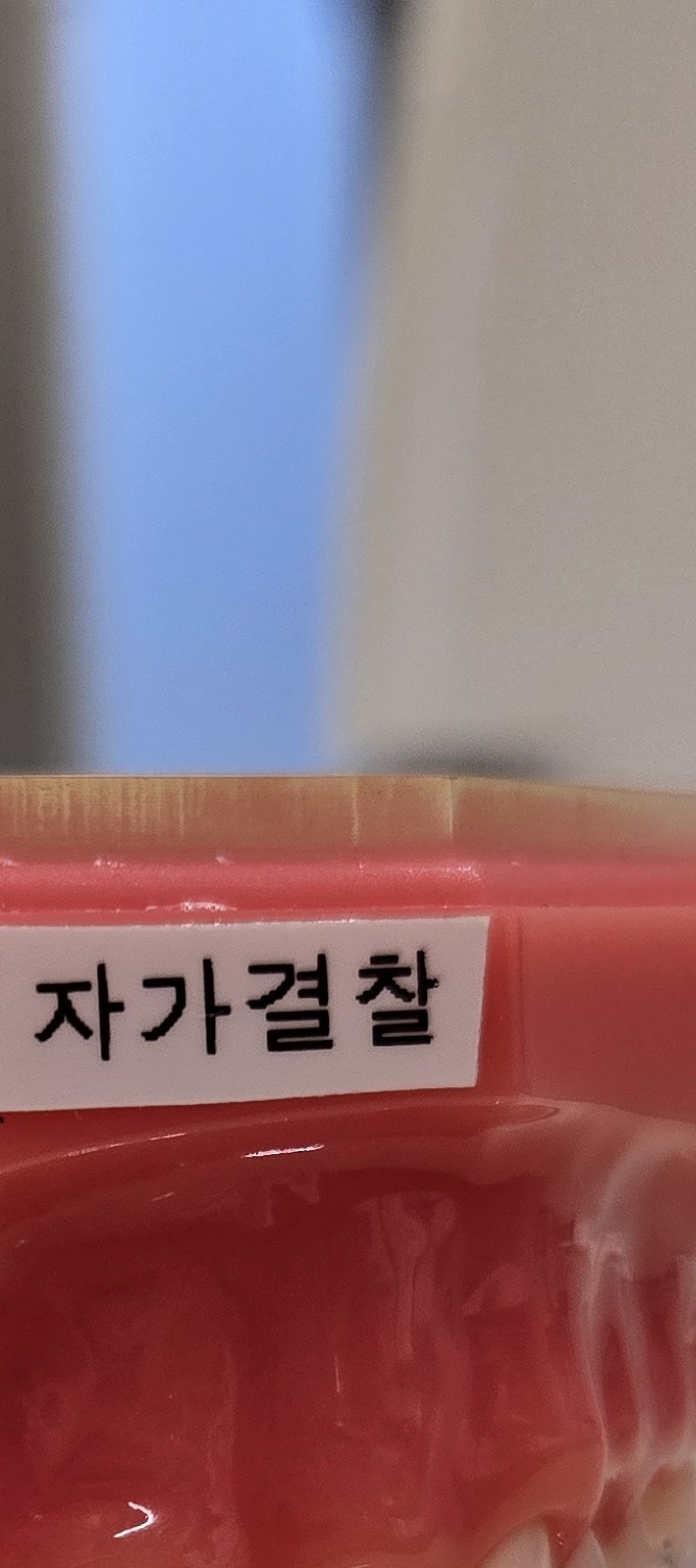 송곳니 덧니 발치 이럴때 해당되네요 관련 이미지 27