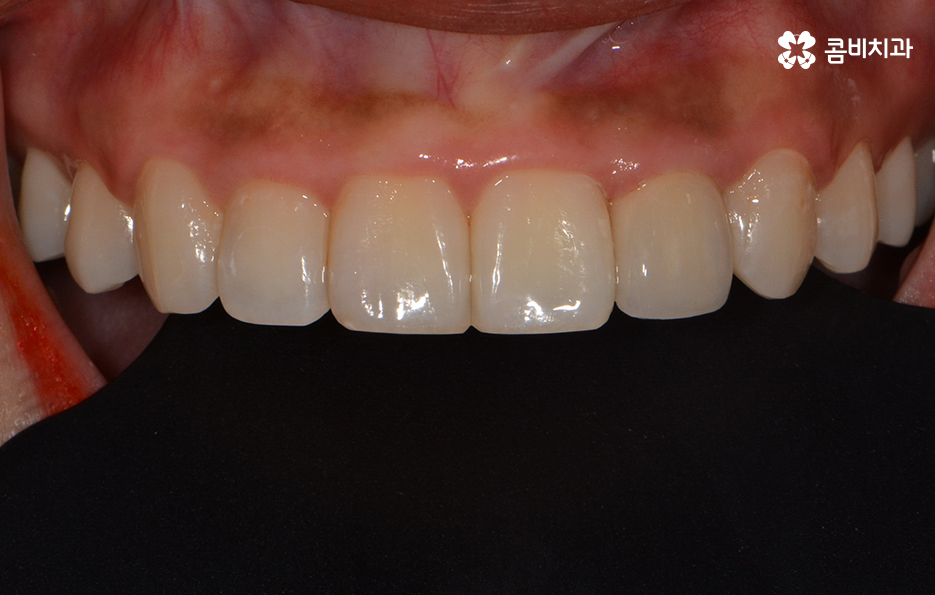 앞니 충치치료 개인에 따라 달라지는 이유 관련 이미지 2
