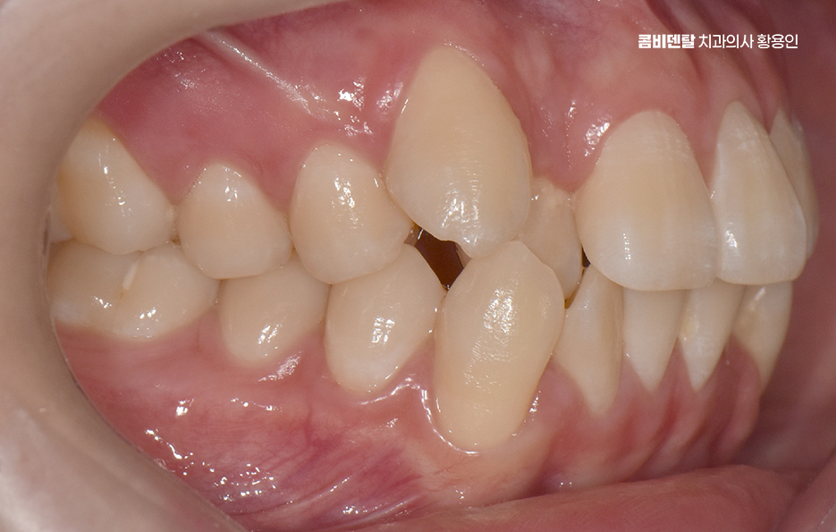 송곳니 덧니 발치 이럴때 해당되네요 관련 이미지 4