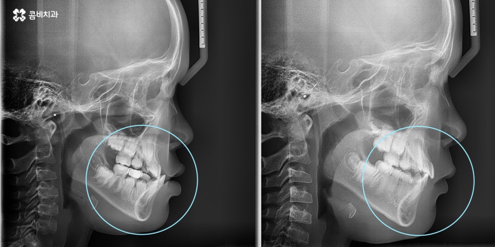 성장기치아교정 어떻게 접근하는 것이 좋을까 관련 이미지 9
