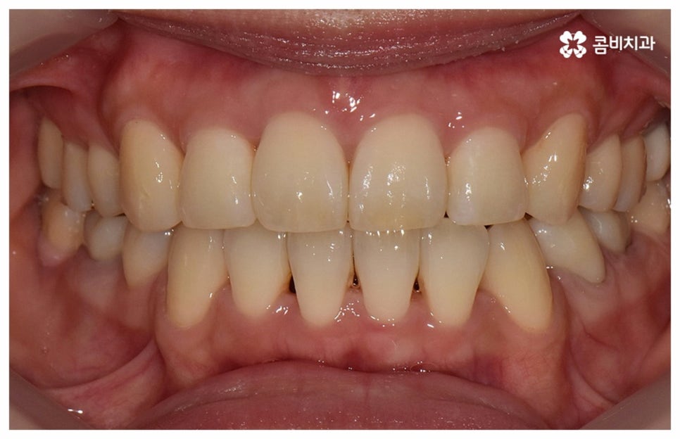 중년치아교정 원한다면 관련 이미지 15