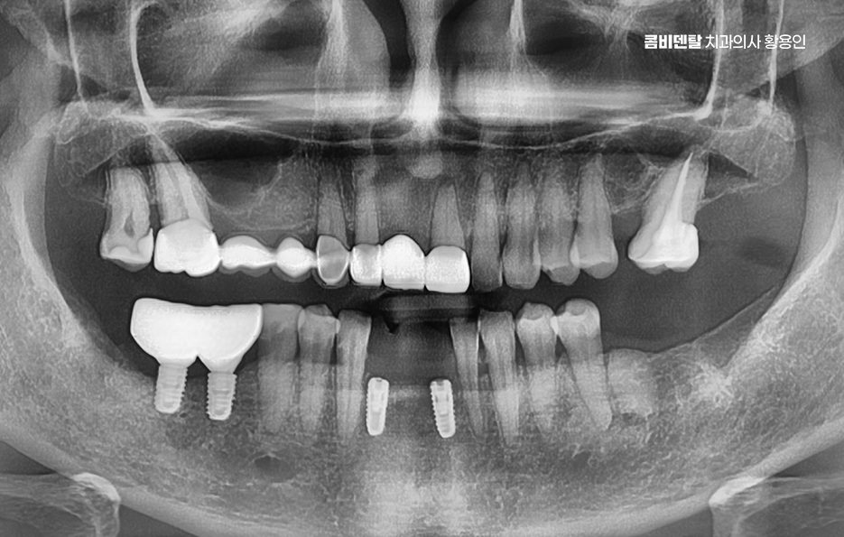 임플란트의 장점 할까 말까 고민이신 분들을 위한 정리 관련 이미지 6