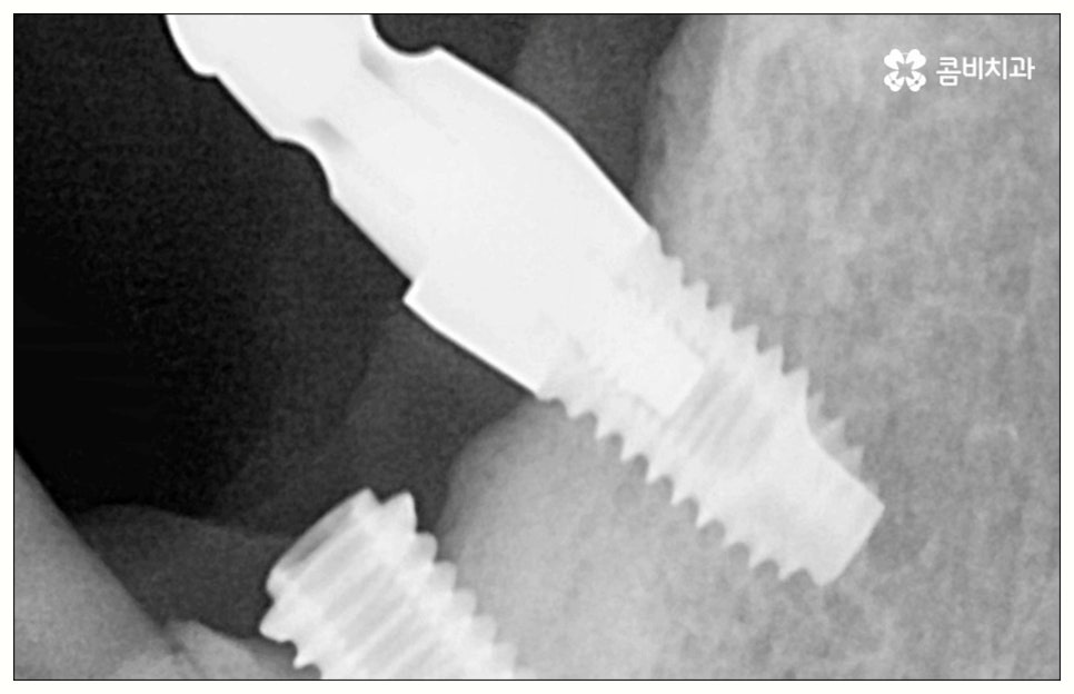 원데이임플란트 어떤가요? 관련 이미지 9
