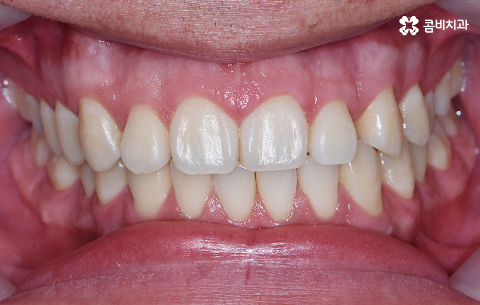 치아부분교정 내게도 적합한지 알아보려면 관련 이미지 8