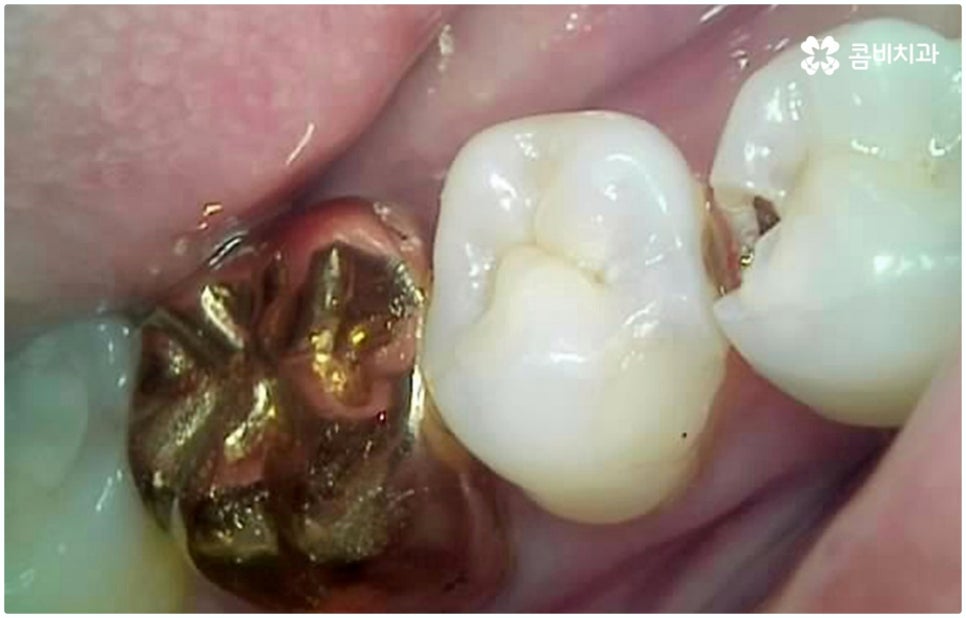 원데이임플란트 받고 싶으신가요? 관련 이미지 4