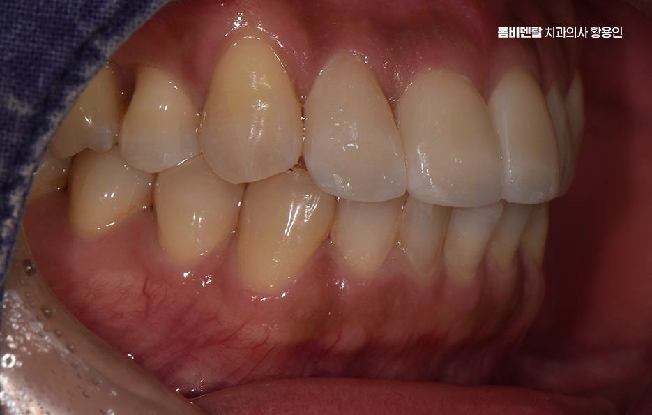 How to Use Laminate Veneers for Chipped Front Teeth image 9
