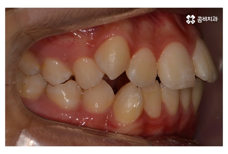 중학생치아교정 세심하게 체크하려면 관련 이미지 2