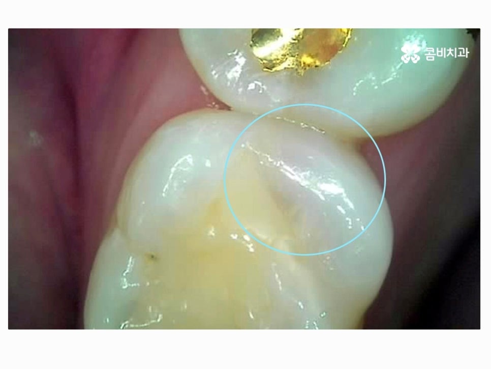 명동치과 누구나 놓치기 쉬운 문제점은! 관련 이미지 2