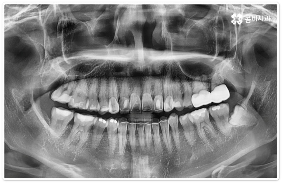 누운사랑니발치 이모저모 알아봐요 관련 이미지 3