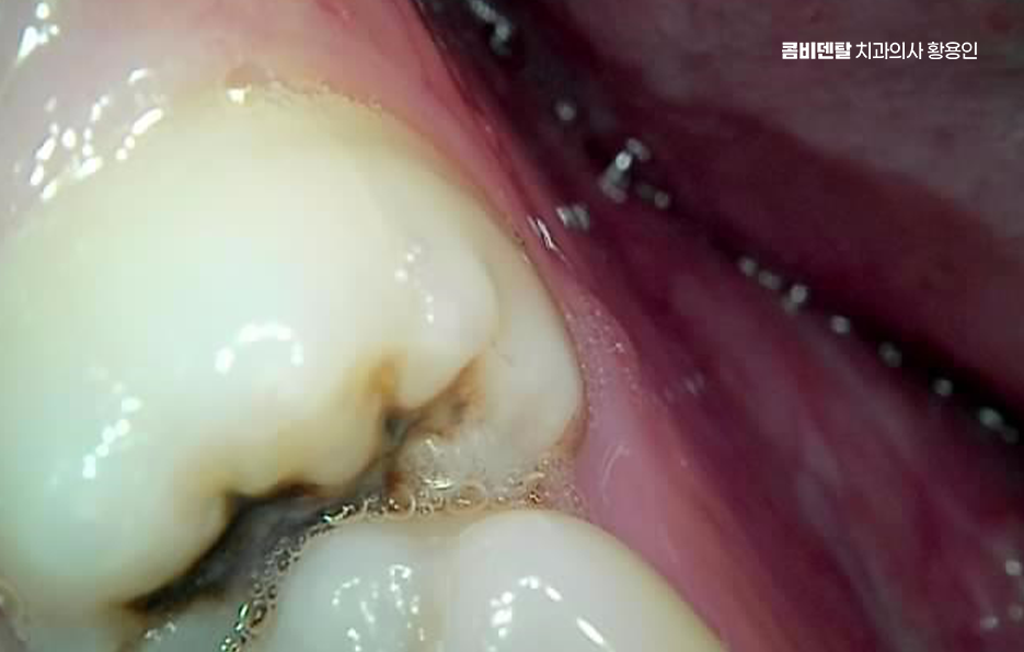 How to Systematically Prepare for Wisdom Tooth Extraction Due to Cavities image 3