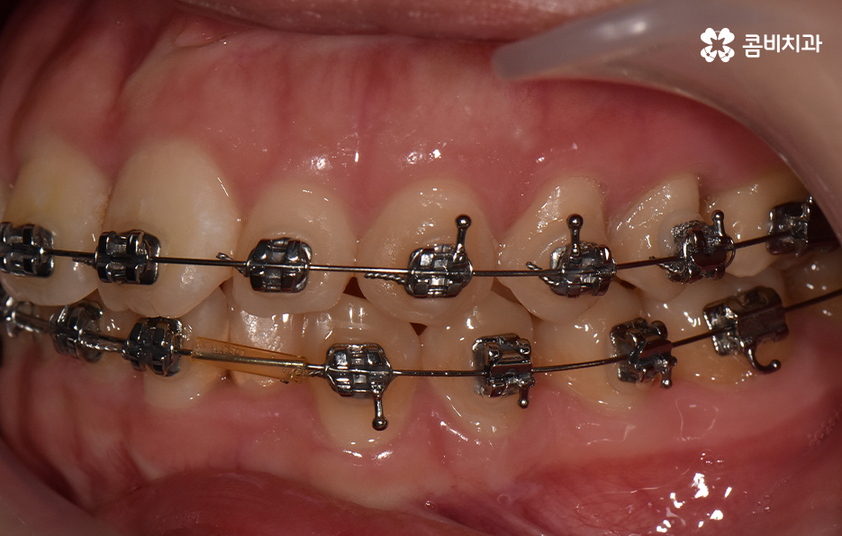 앞니 틀어짐 교정으로 해결하면 될까요 관련 이미지 9