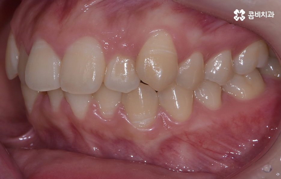 덧니 비발치 교정 자연스럽게 가능한 경우도 있어요 관련 이미지 2