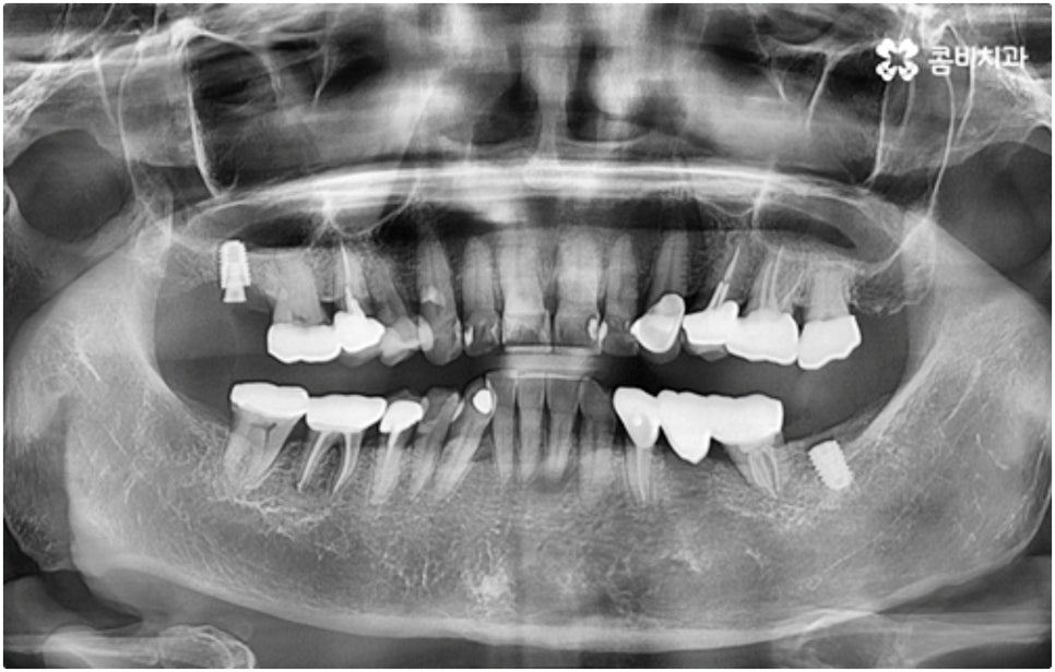 어금니임플란트 살펴볼 사항들은 무엇인가요? 관련 이미지 6