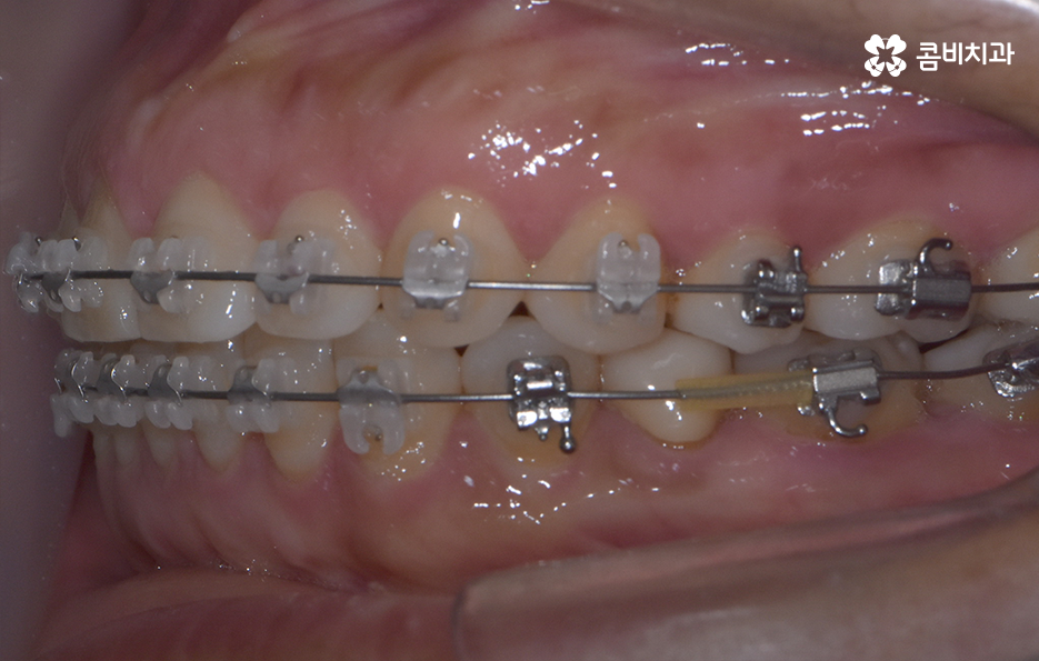 중년치아교정 이제라도 해도 될까요 관련 이미지 12