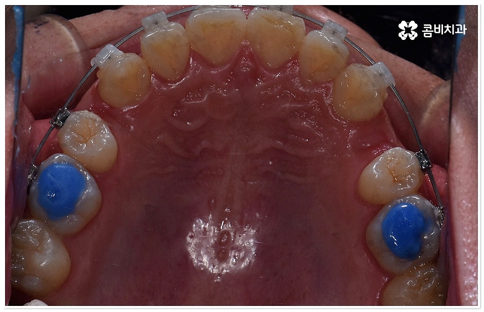 덧니치아교정 고려할 사항들은 관련 이미지 4