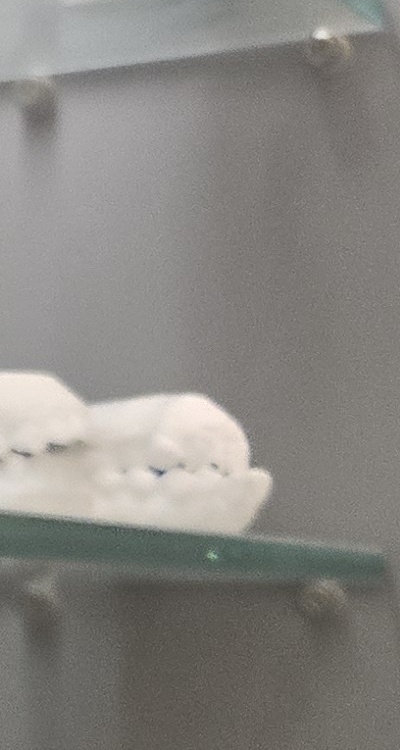 앞니 틀어짐 부분교정 얼마나 걸릴까 관련 이미지 29