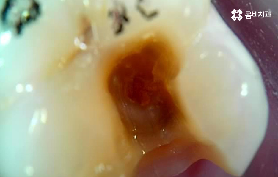 충치 신경치료 안하면 후회하는 이유 관련 이미지 11